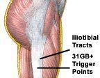 The illiotibial tract and location of GB31 and adjacent trigger points.