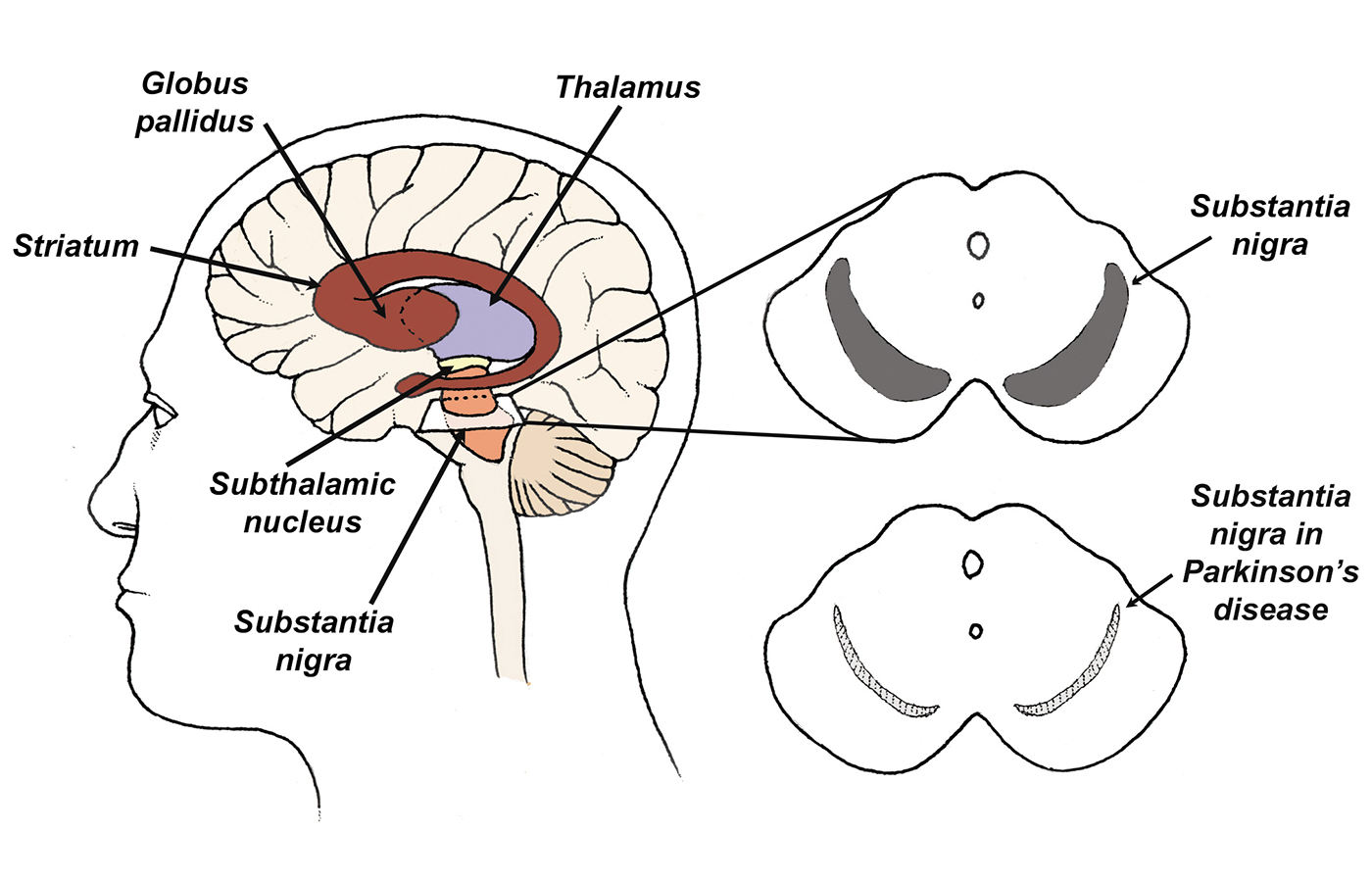 Early Parkinson’s disease clues Early Parkinson’s disease clues