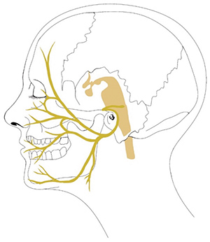 Facial nerve involvement in HFS