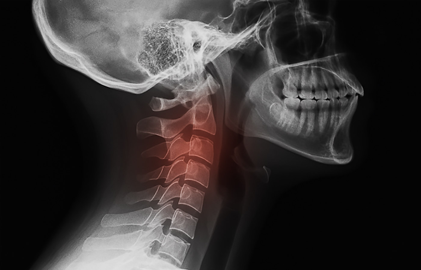 Chronic Neck Pain