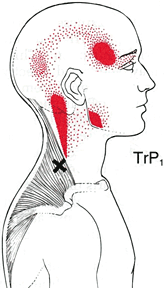 Which Trigger Points Cause TMJ?