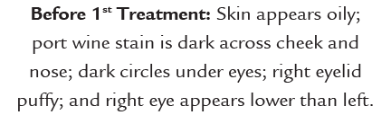 Before 1st Treatment: Skin appears oily; port wine stain is dark across cheek and nose; dark circles under eyes; righ...
