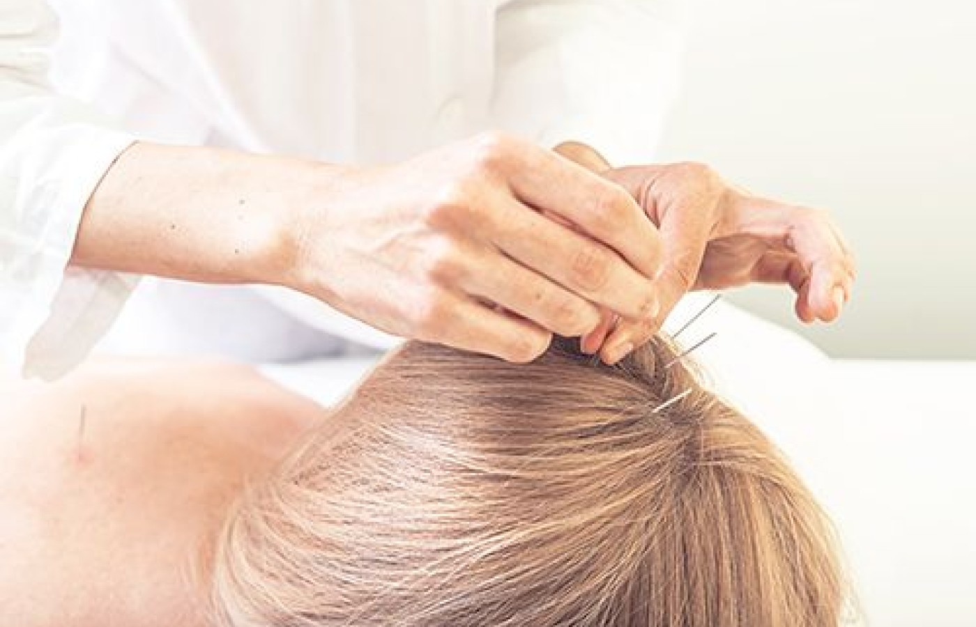 scalp acupuncture