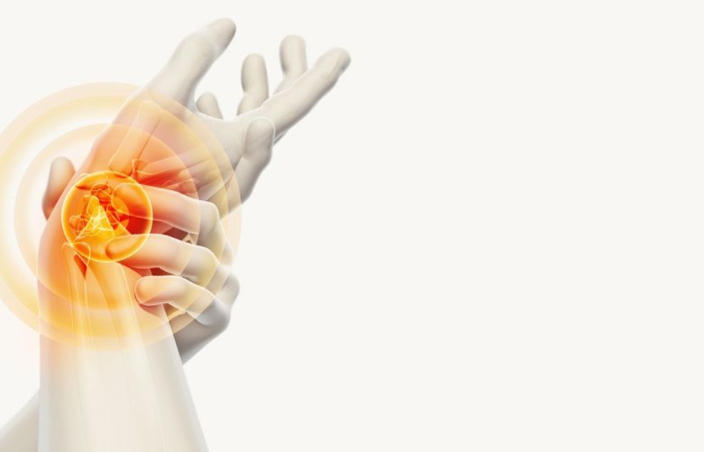 Carpal Tunnel Syndrome