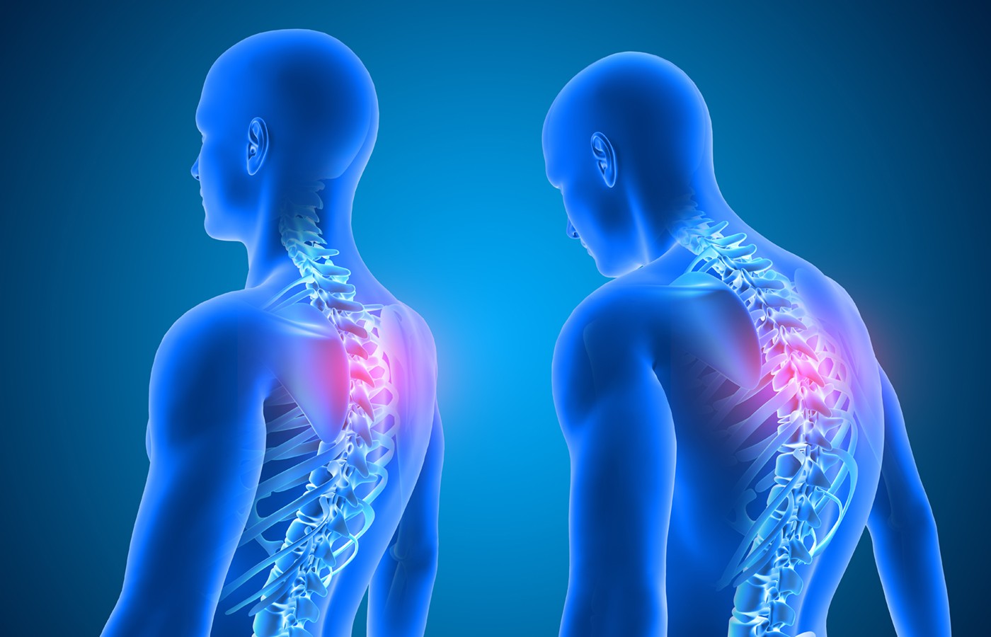 Trigger-Point Acupuncture for Posture Alignment