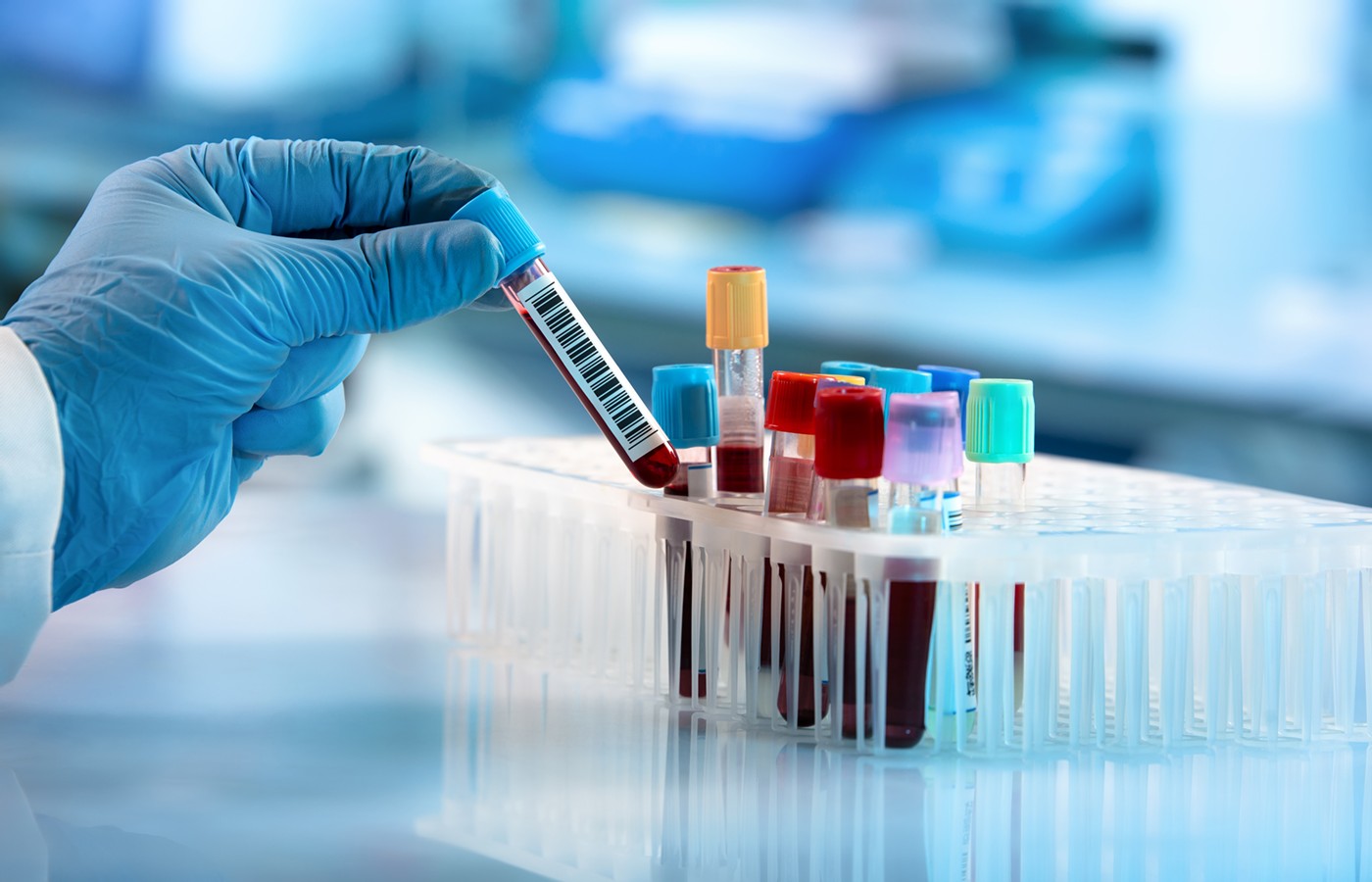 New Blood Biomarkers for Alzheimer's, Parkinson's, MS and Traumatic Brain Injury