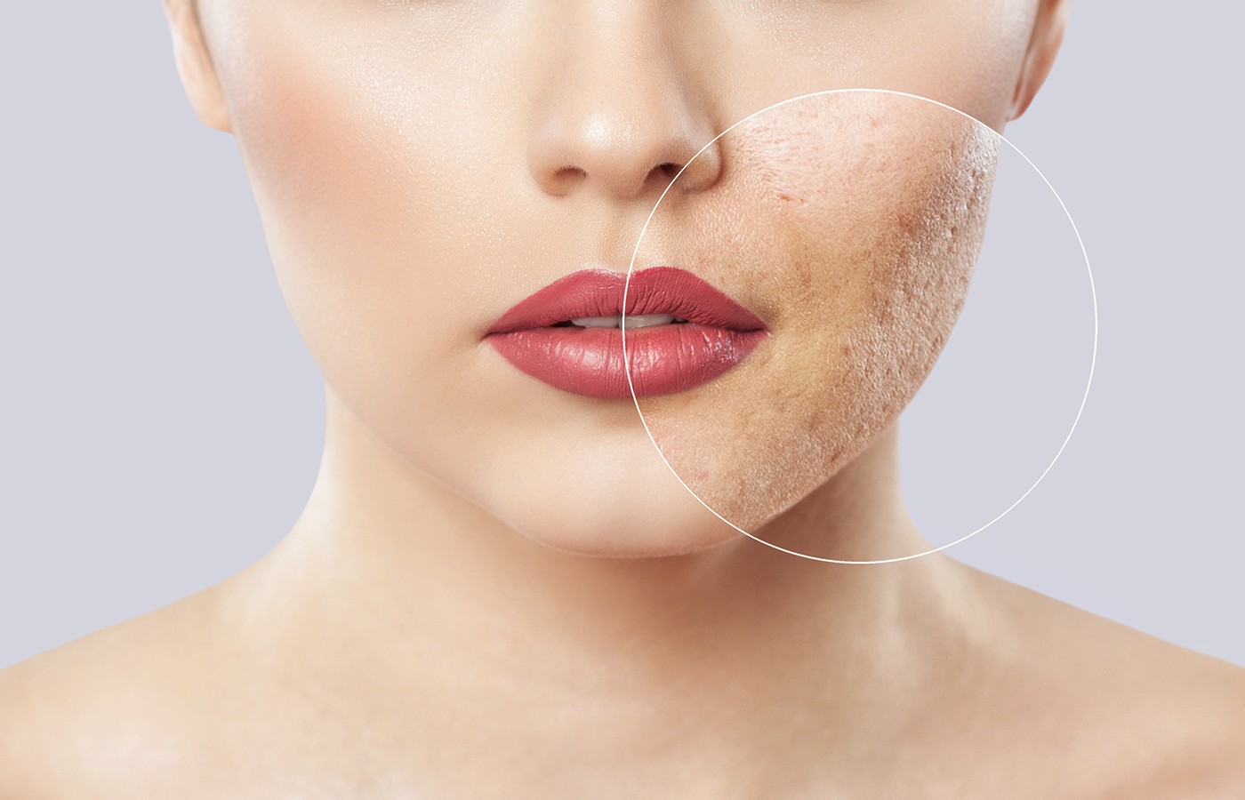 Microneedling for Acne / Acne Scars