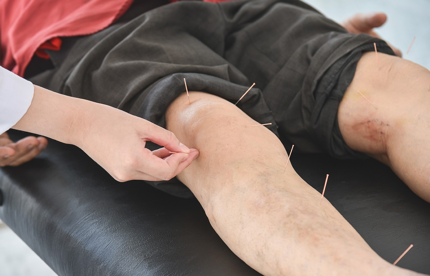 Acute Pain: Needling Opposite Sides