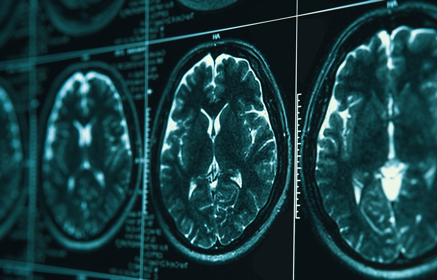 Objective Indicators of Brain MRI Changes After Acupuncture Treatment for Stroke