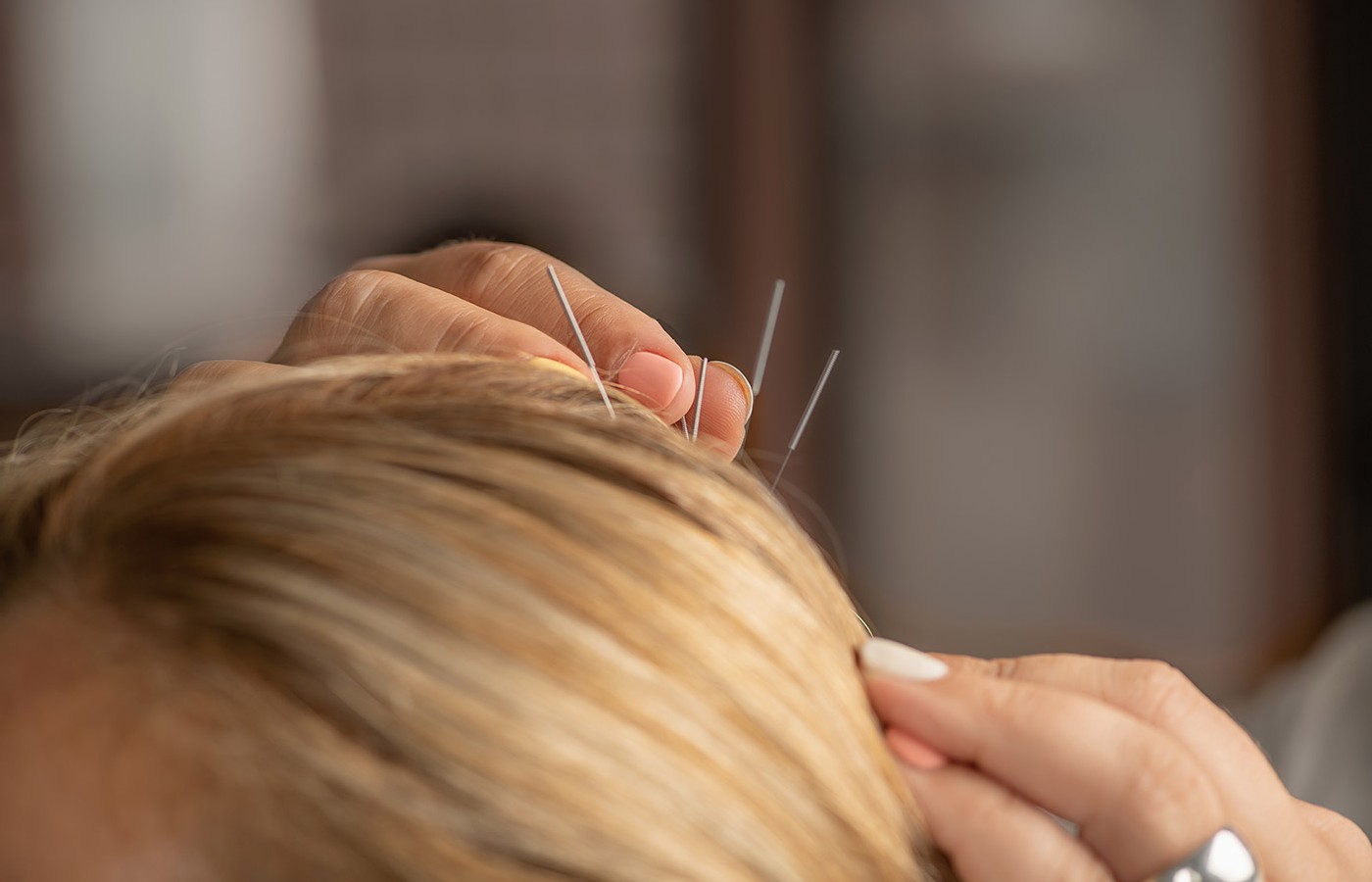 Objective Indicators of Brain MRI Changes After Acupuncture Treatment for Stroke