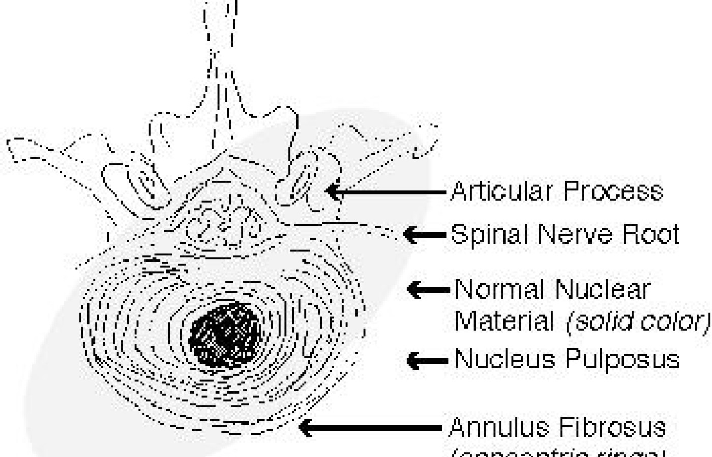 Normal intervertebral disc.