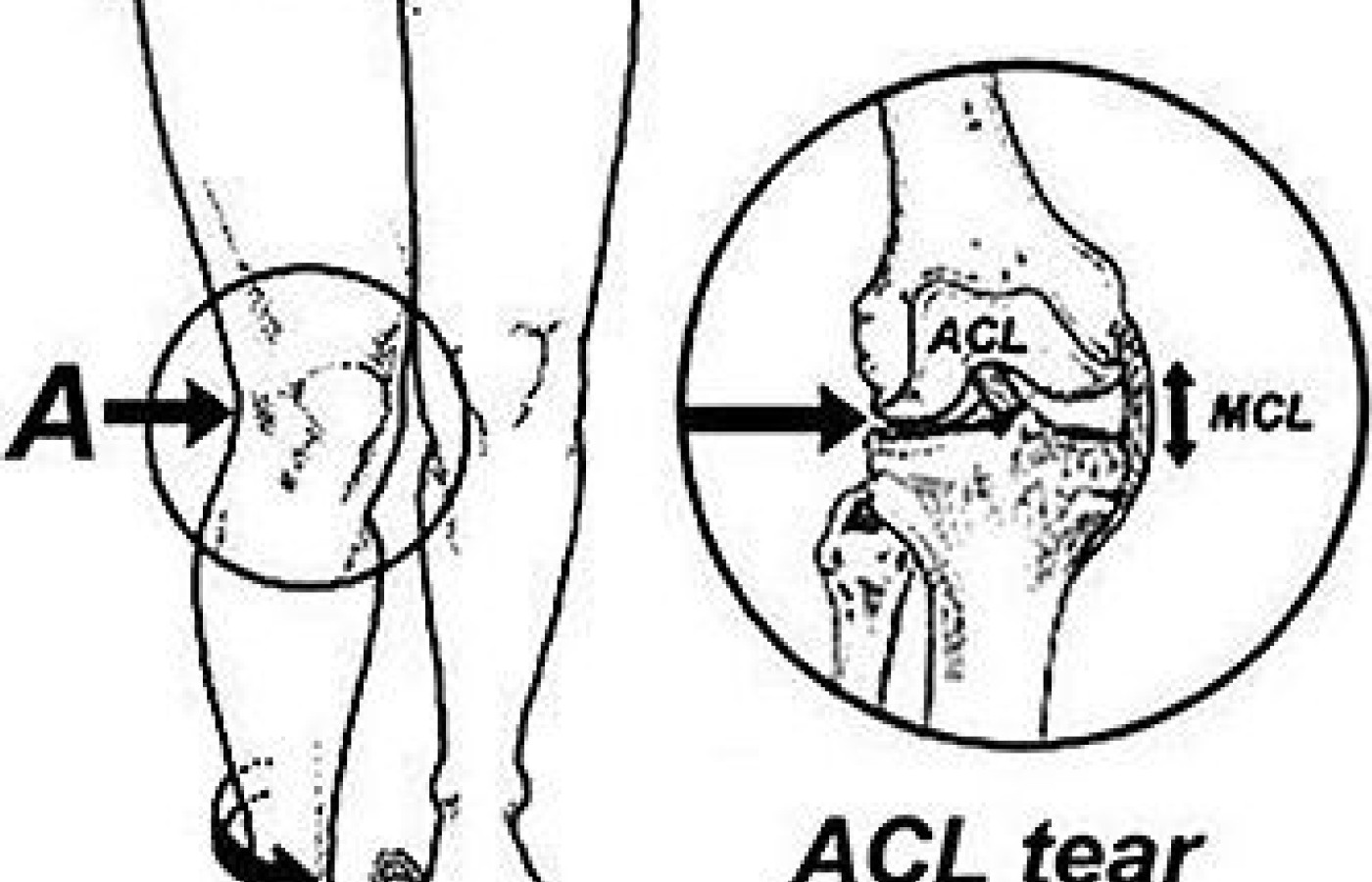 acl tear