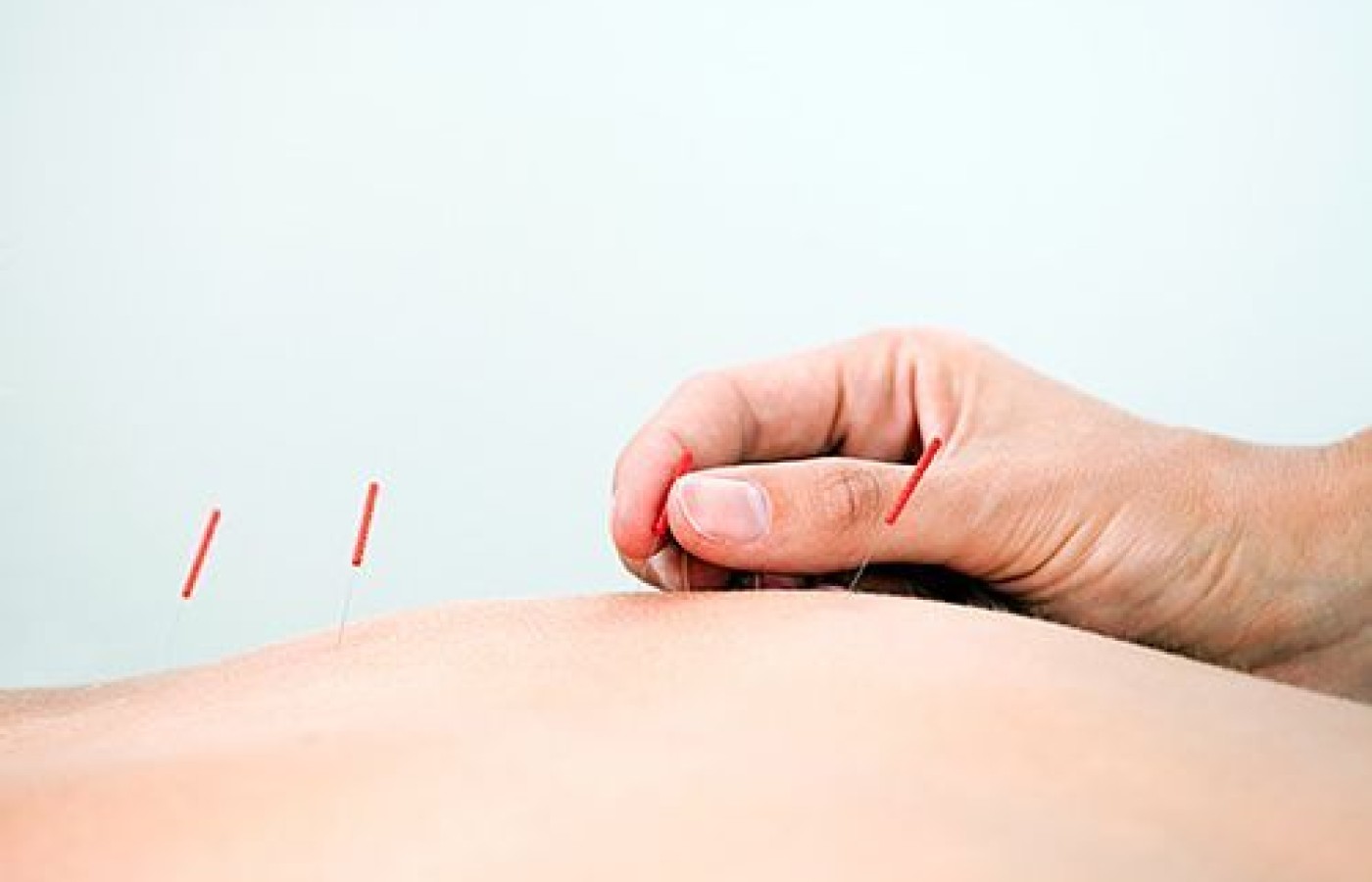 acupuncture