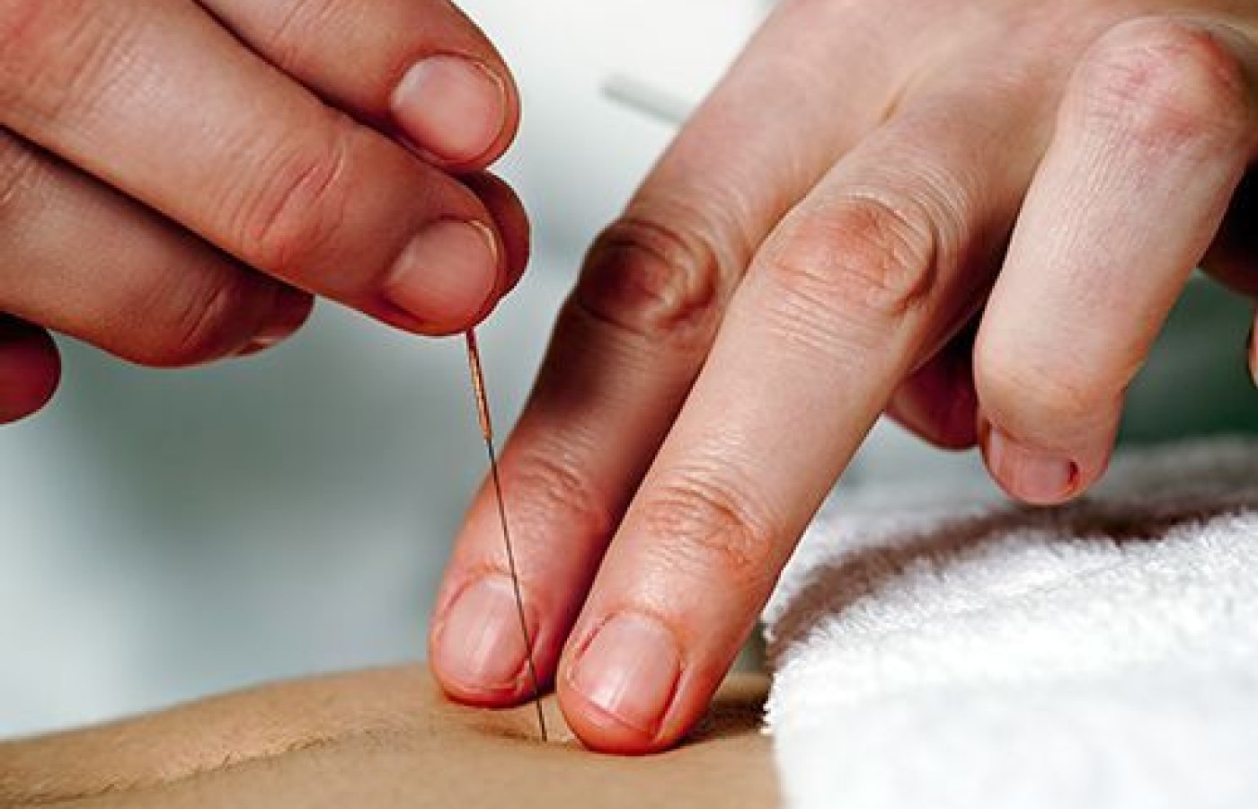 acupunctre