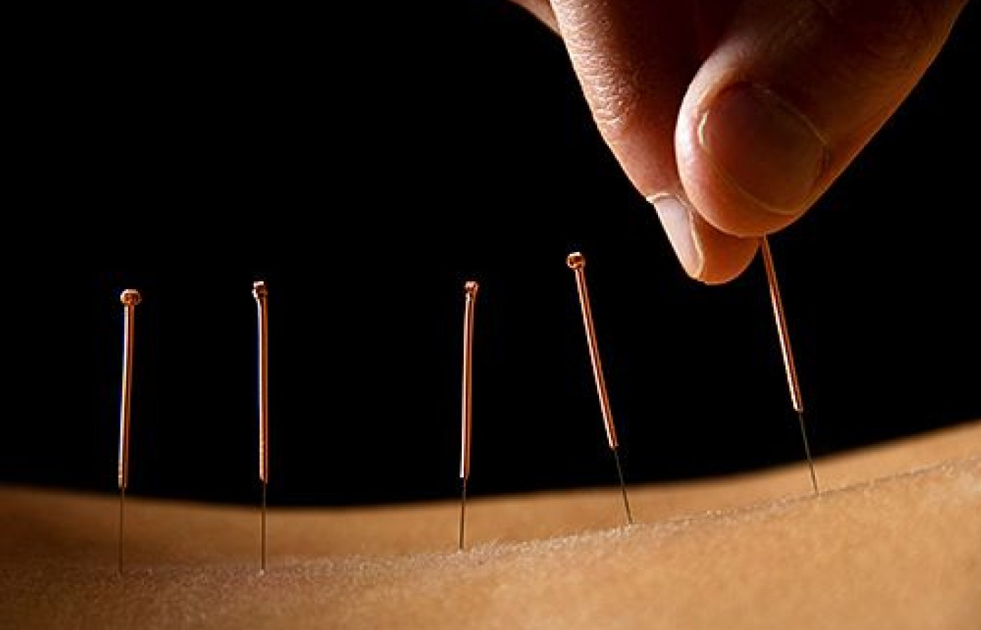 acupuncture needles