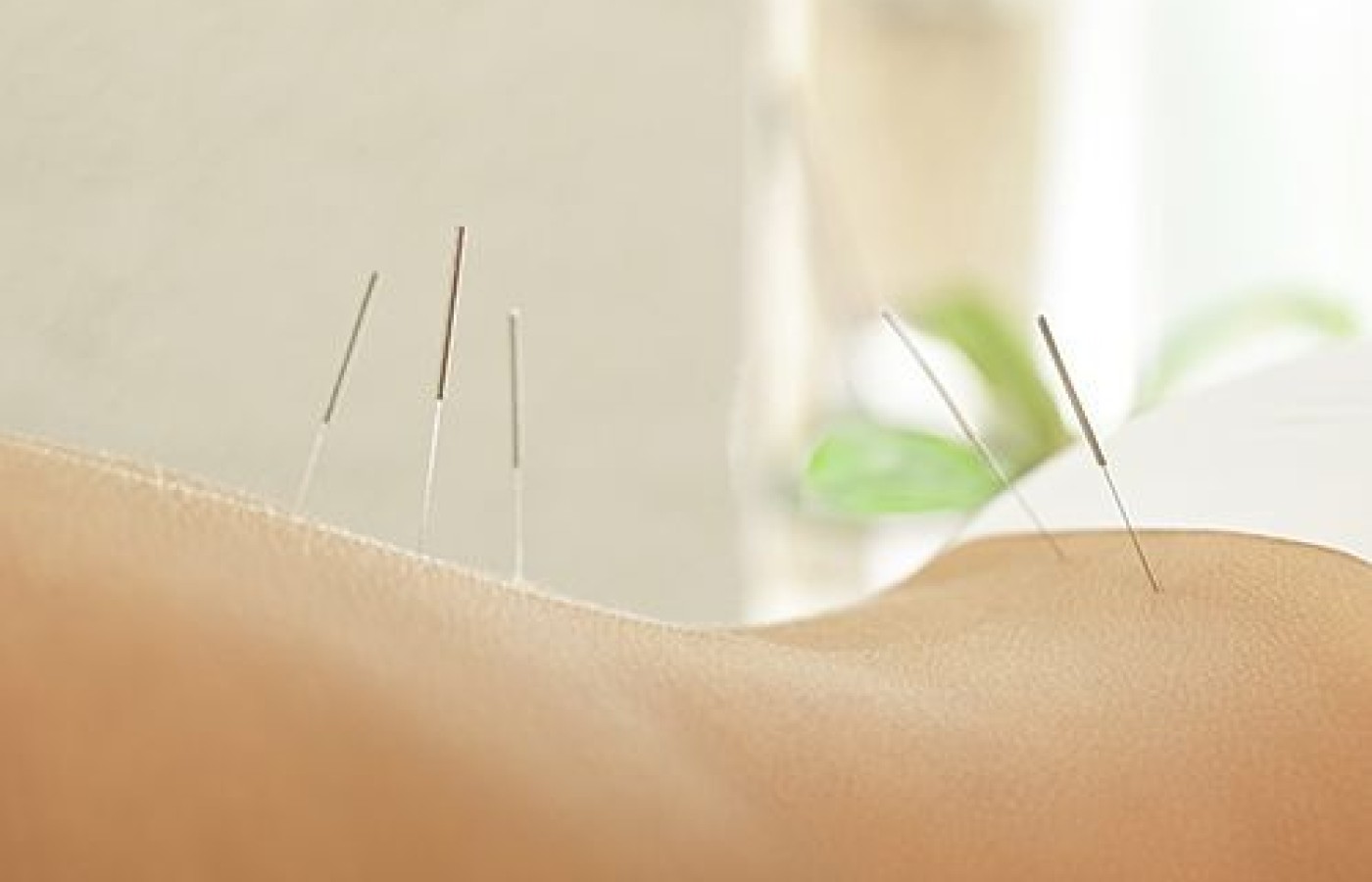 acupuncture treatment