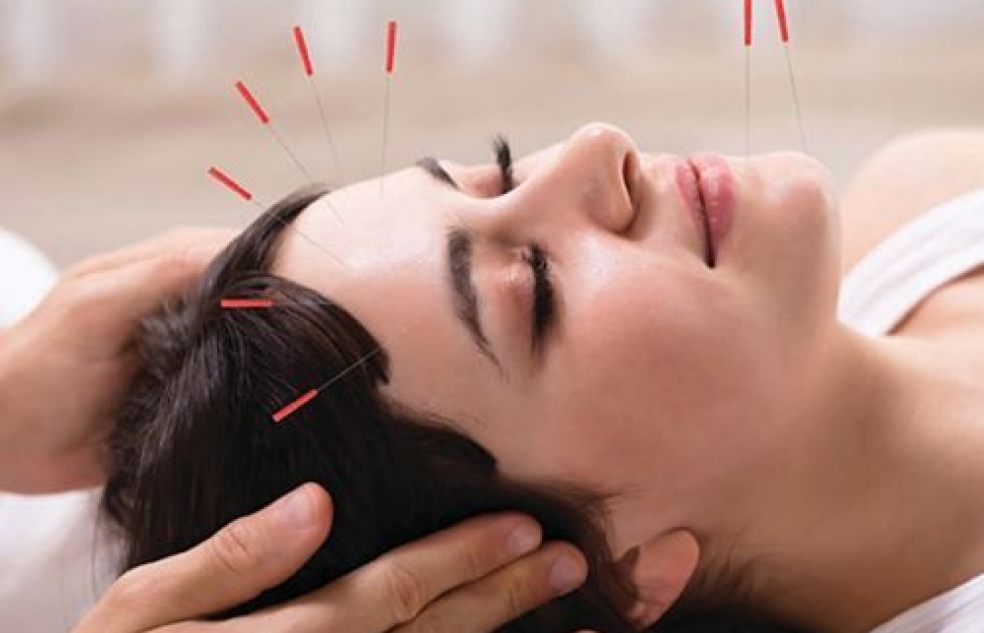 facial acupuncture