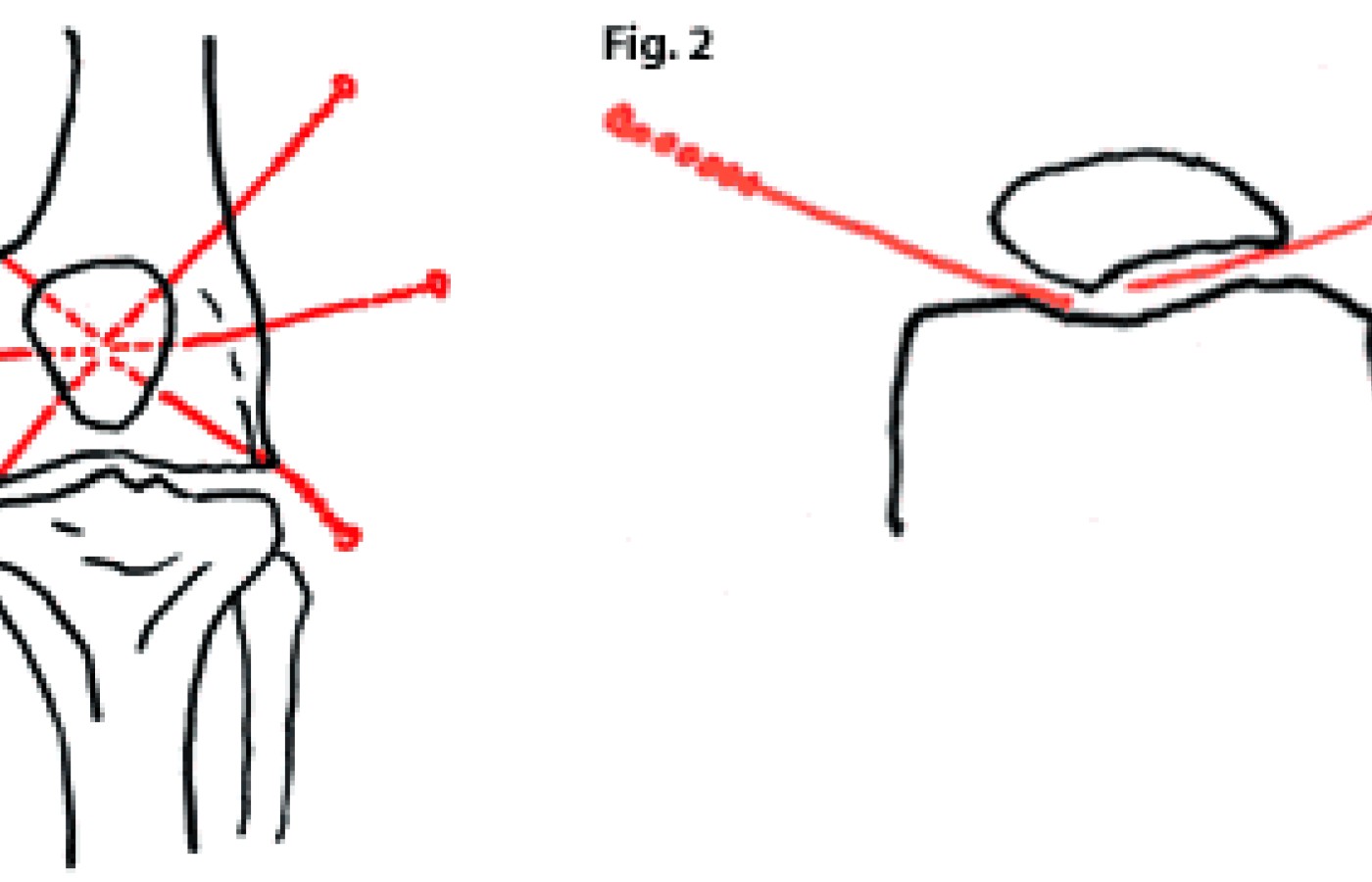 Insertion of acupuncture needles for the treatment of chondromalacia patellae.