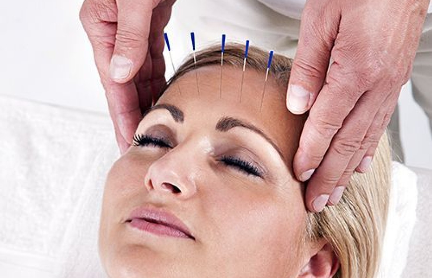 head acupuncture