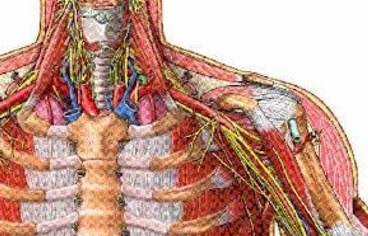 Illustration of Thoracic outlet syndrome.