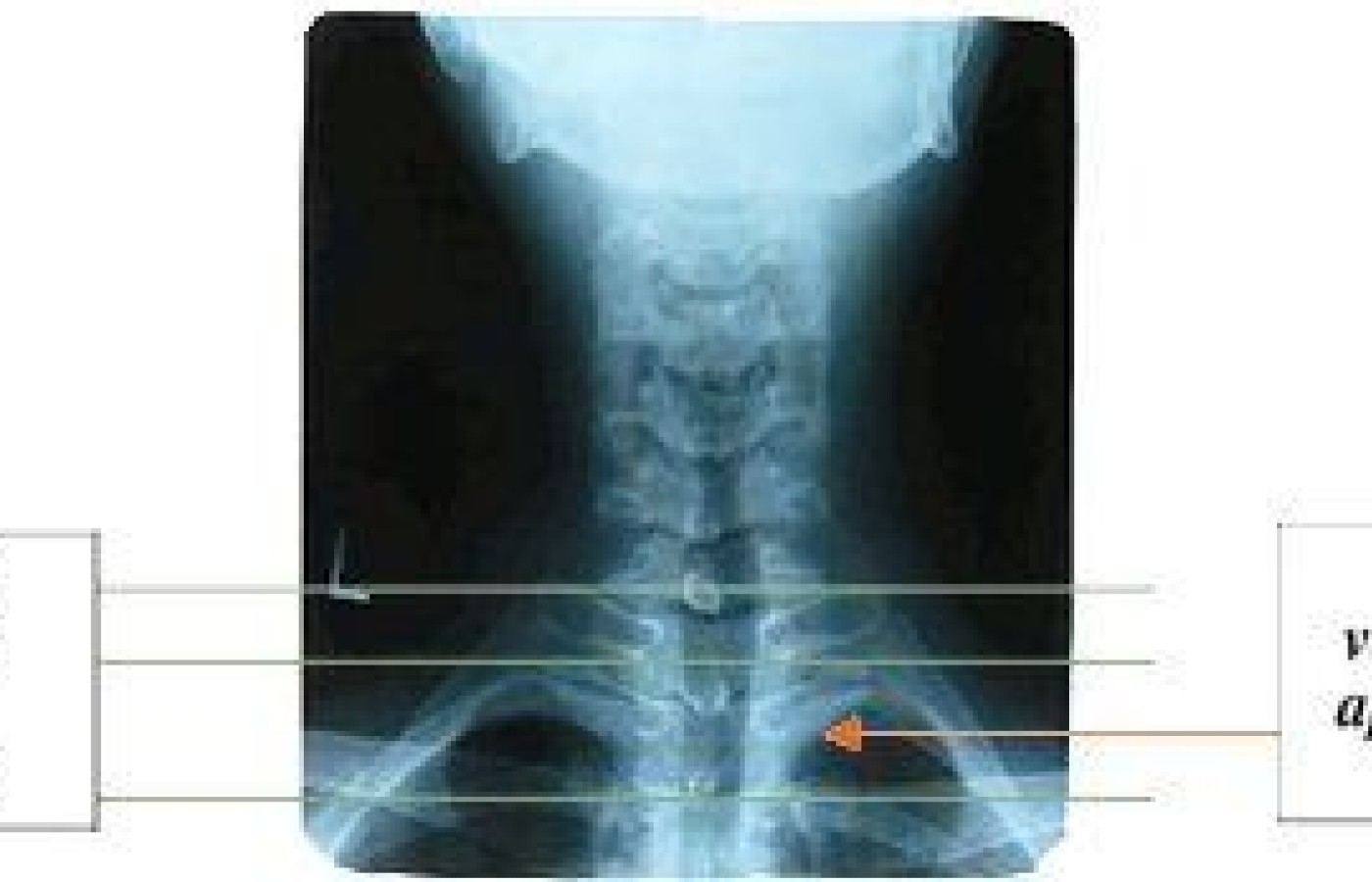 Posteroanterior view to expose apex of lungs.