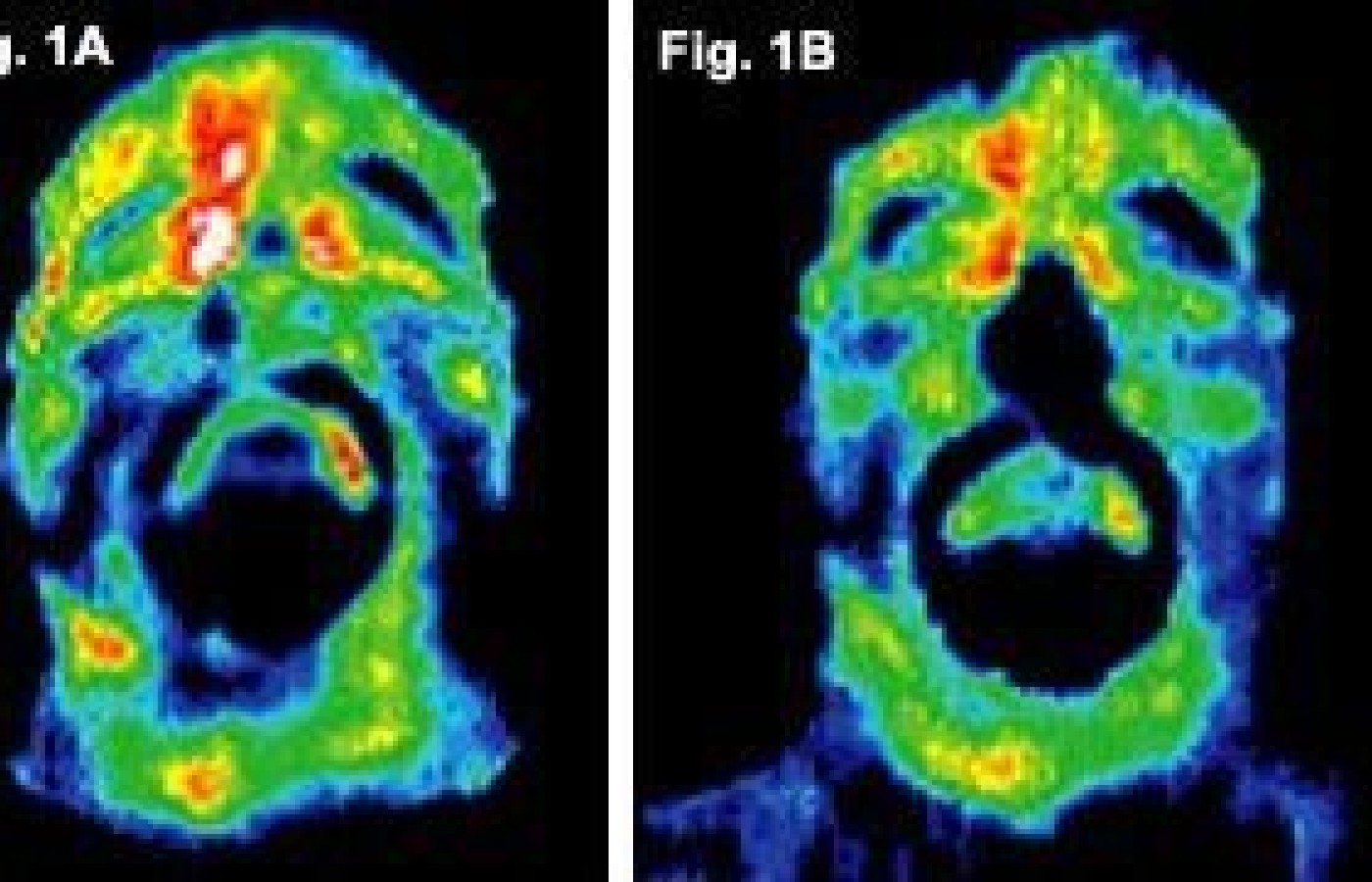 Before and after infrared images of the face of first volunteer.