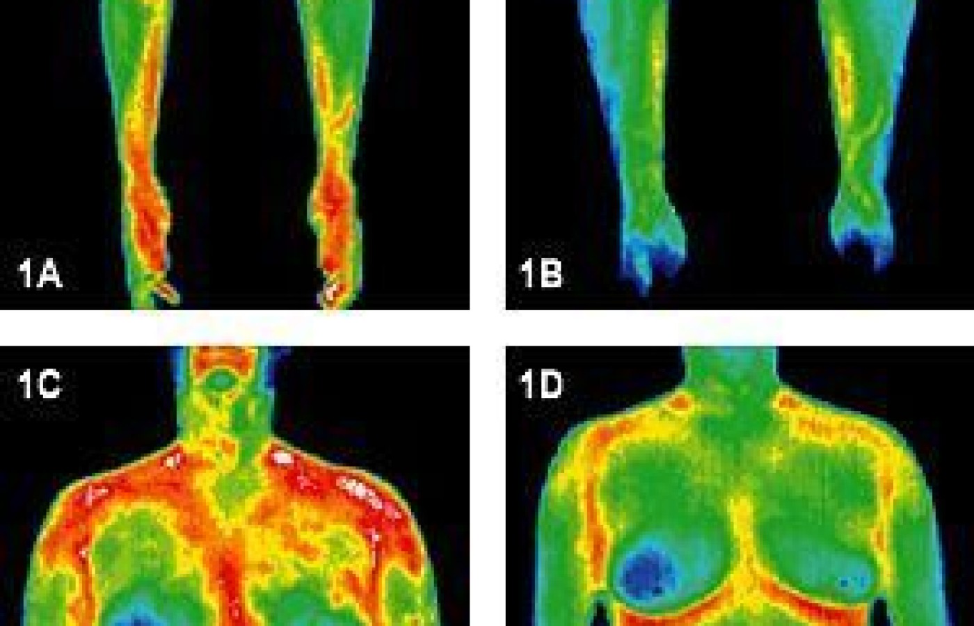 Infrared images of arms and torso before and after treatment.