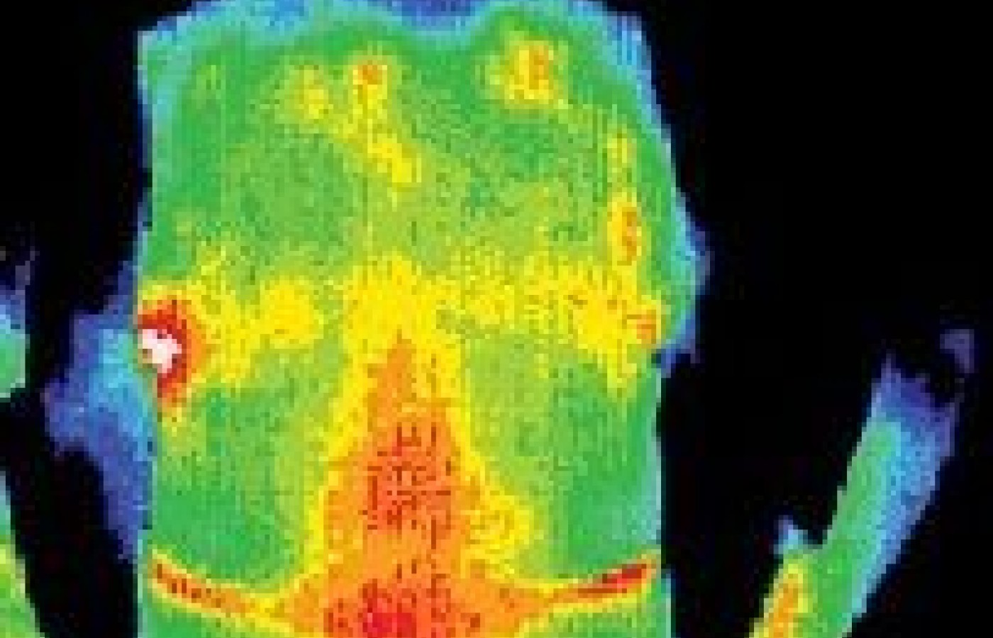 Infrared image of patient before treatment by acupuncture.