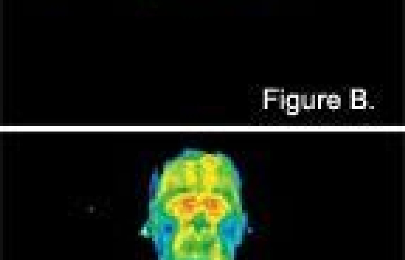 Infrared pictures of an acuppressure patient.