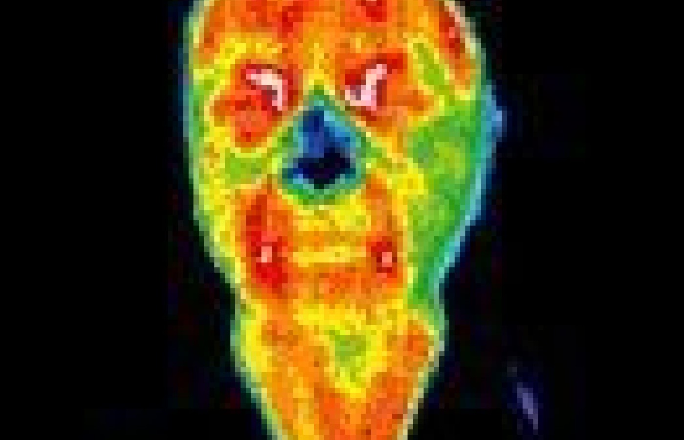 Infrared image of acupuncture patient.