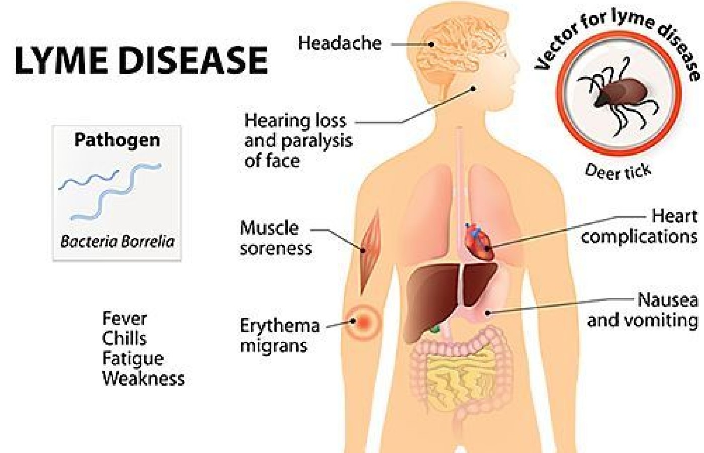 lyme disease