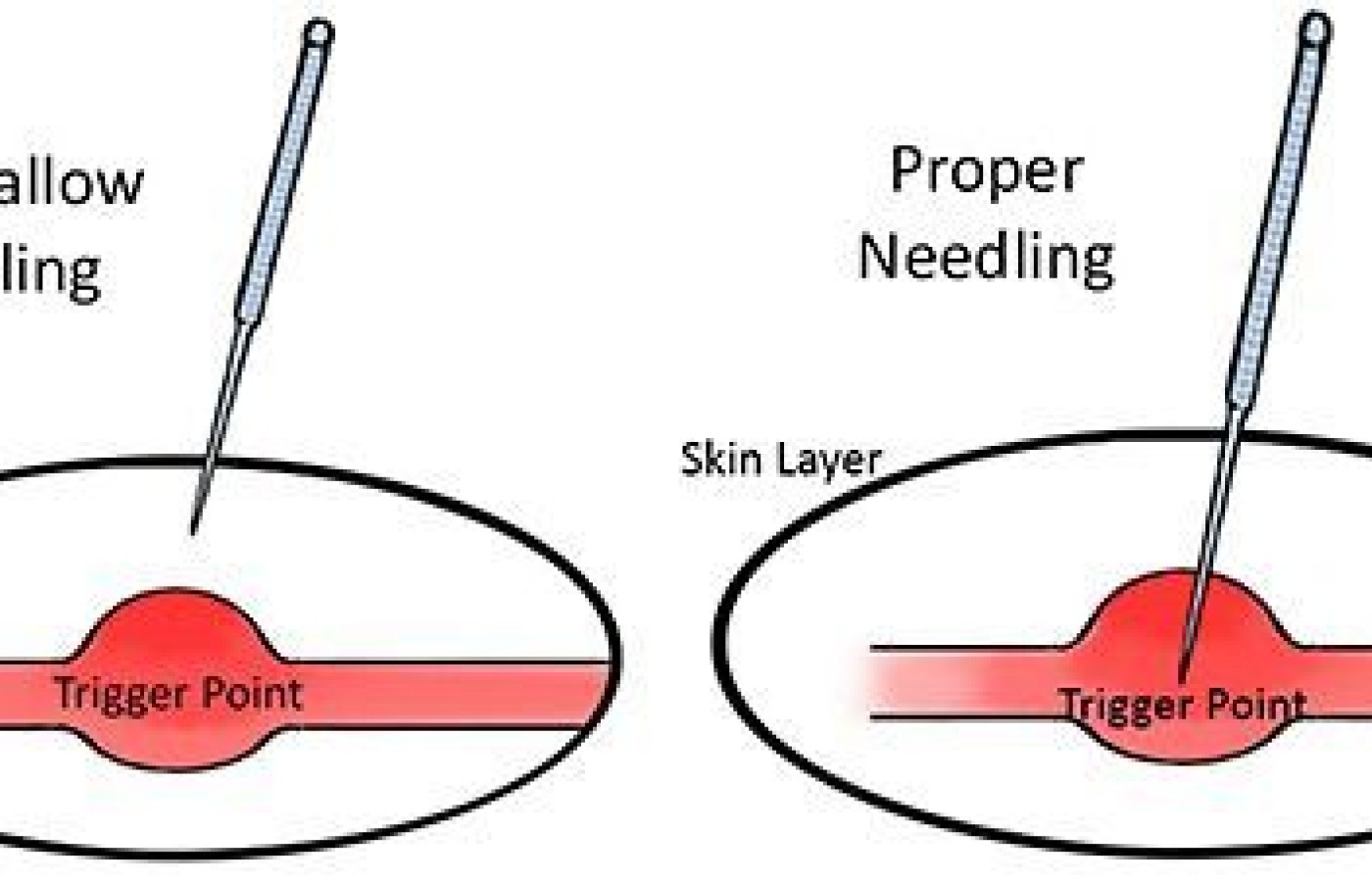 needling