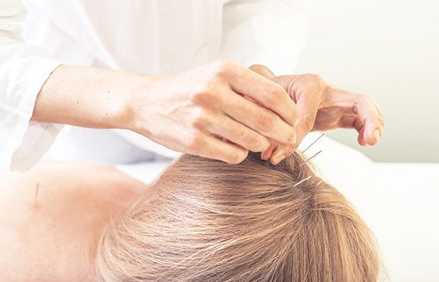 scalp acupuncture