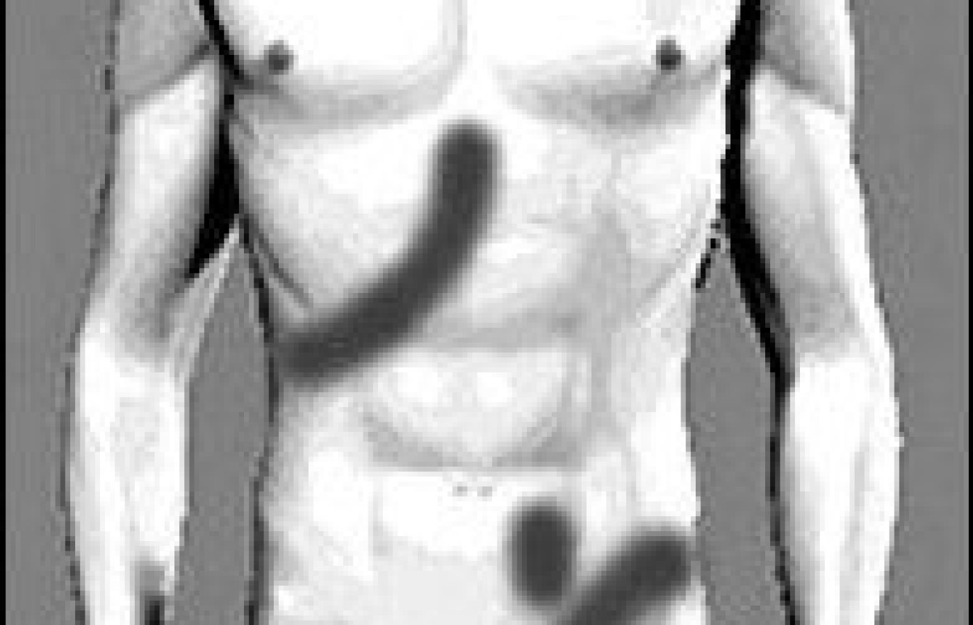 Illustration of Cross Syndrome.