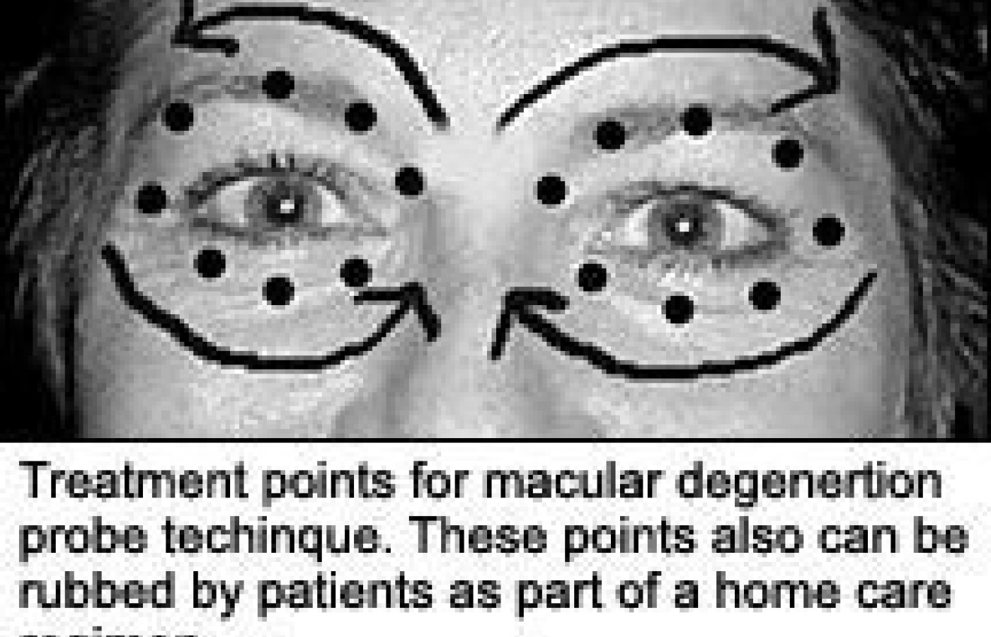Treatment points for macular degeneration probe technique.