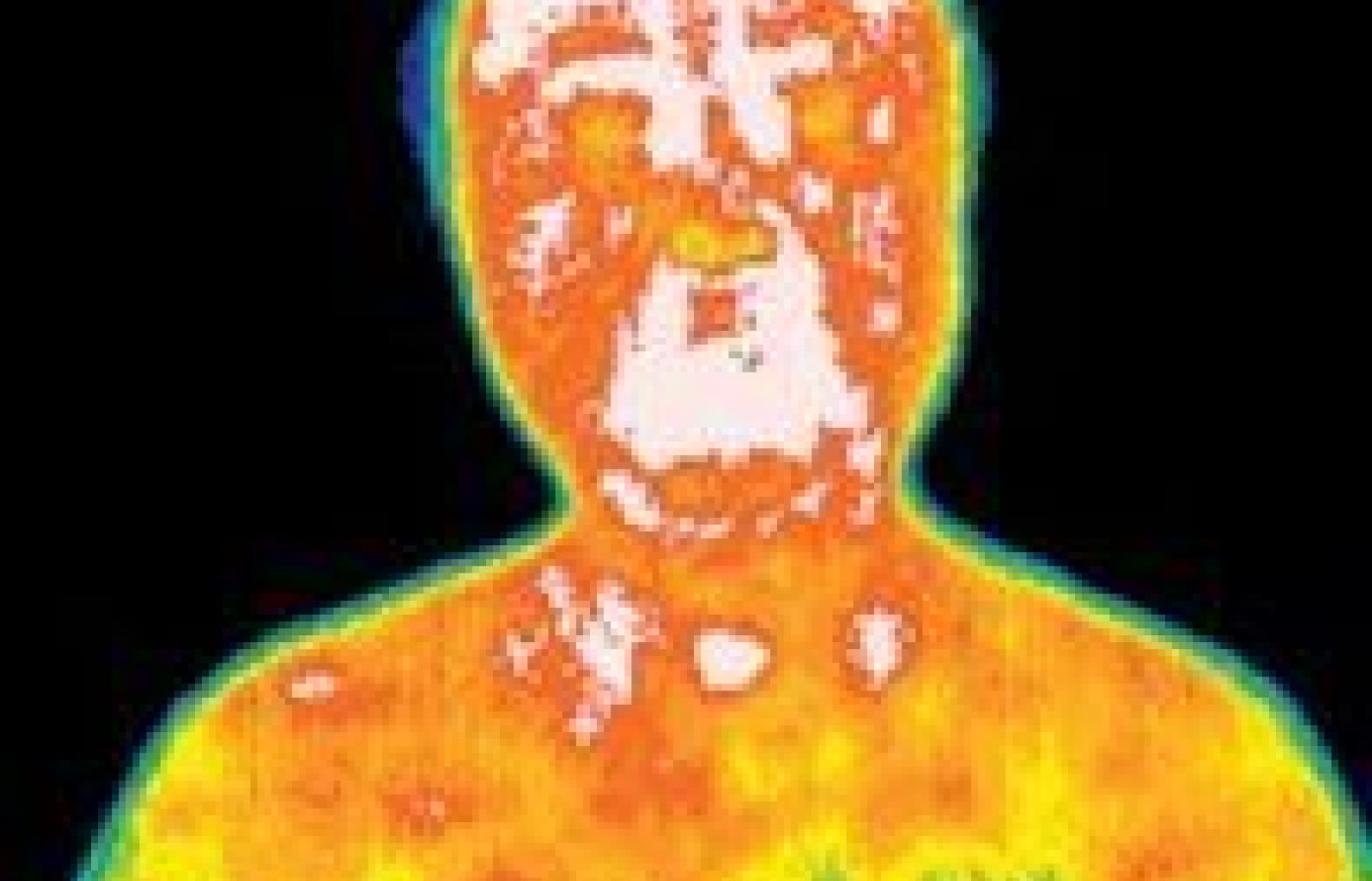 Infrared picture of a patient before acupuncture treatment.